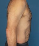 after tummy tuck male patient right side view case 1704