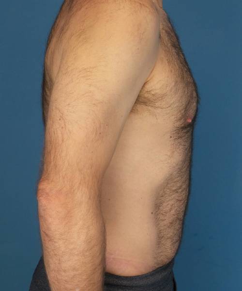 after tummy tuck male patient right side view case 1704