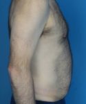 before tummy tuck male patient right side view case 1704