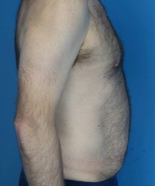 before tummy tuck male patient right side view case 1704