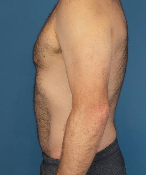 after tummy tuck male patient left side view case 1704