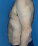 before tummy tuck male patient left side view case 1704