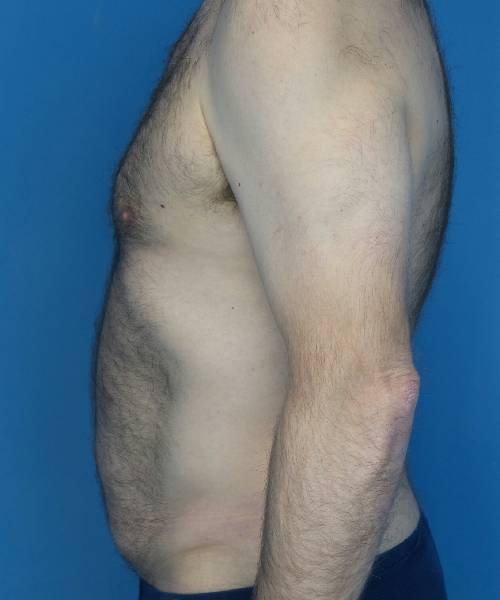 before tummy tuck male patient left side view case 1704