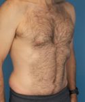 after tummy tuck male patient right angle view case 1704