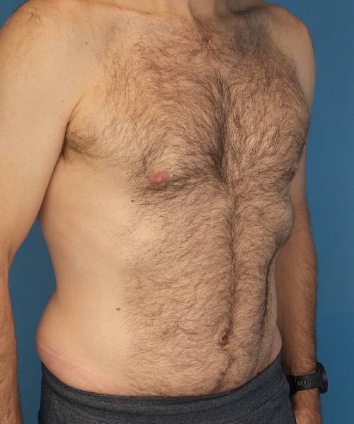 after tummy tuck male patient right angle view case 1704