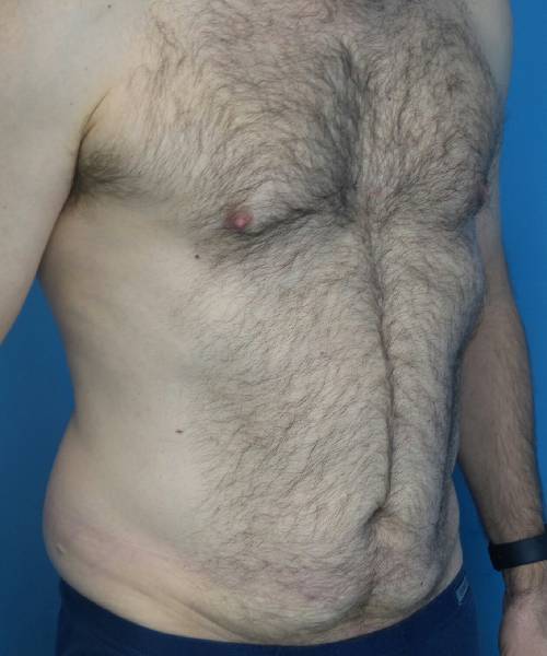 before tummy tuck male patient right angle view case 1704