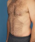 after tummy tuck male patient left angle view case 1704