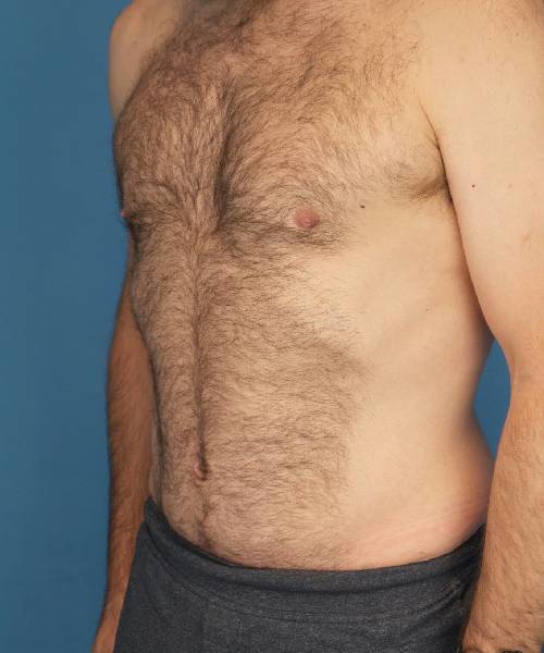 after tummy tuck male patient left angle view case 1704