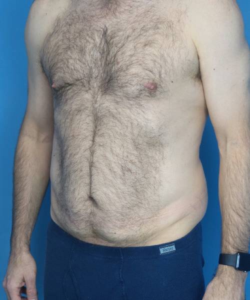 before tummy tuck male patient left angle view case 1704