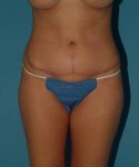 after tummy tuck front view female patient case 1721