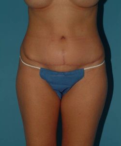 after tummy tuck front view female patient case 1721