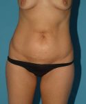 before tummy tuck front view female patient case 1721