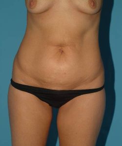 before tummy tuck front view female patient case 1721