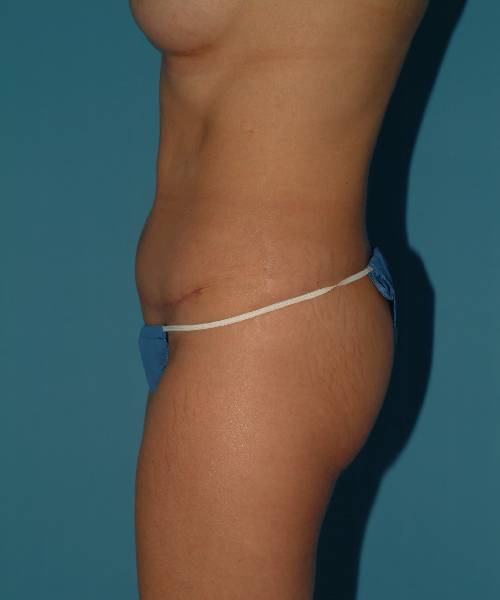 after tummy tuck left view female patient case 1721