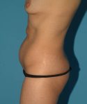 before tummy tuck left view female patient case 1721