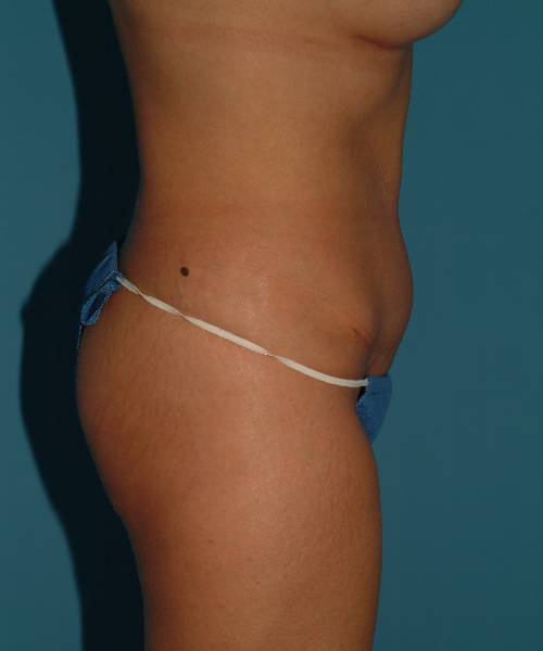 after tummy tuck right view female patient case 1721