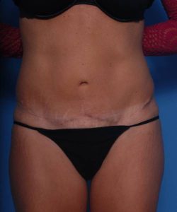 after tummy tuck female patient front view case 1729