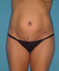 before tummy tuck female patient front view case 1729