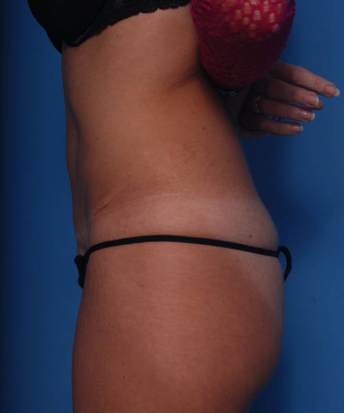 after tummy tuck female patient left side view case 1729