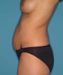 before tummy tuck female patient left side view case 1729