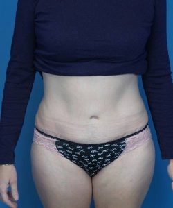 after tummy tuck front view female patient case 1745