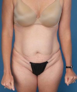before tummy tuck front view female patient case 1745