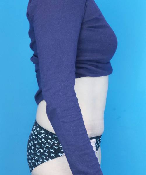 after tummy tuck side view female patient case 1745