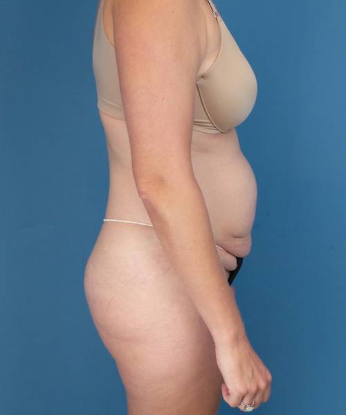before tummy tuck side view female patient case 1745