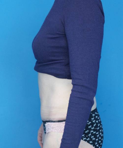 after tummy tuck left view female patient case 1745