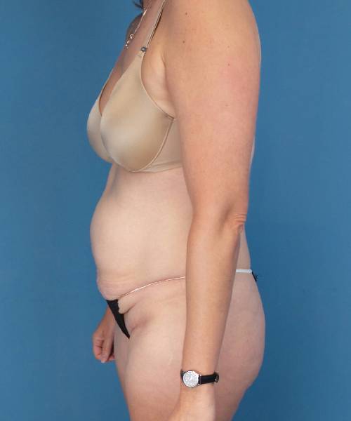 before tummy tuck left view female patient case 1745