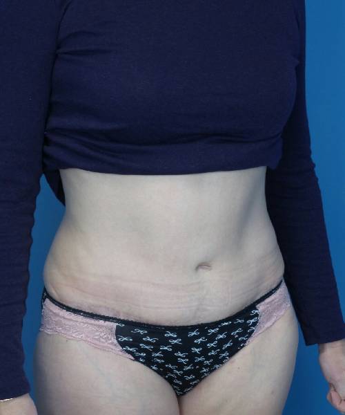 after tummy tuck angle view female patient case 1745