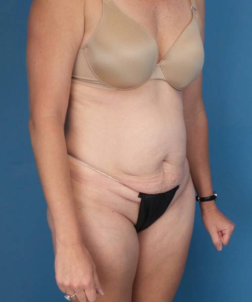 before tummy tuck angle view female patient case 1745