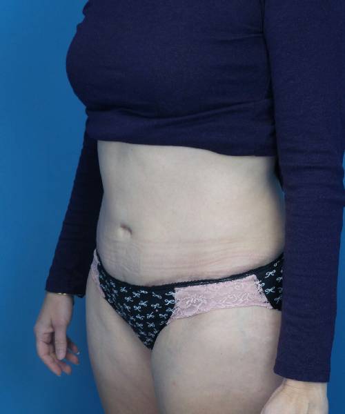 after tummy tuck left angle view female patient case 1745
