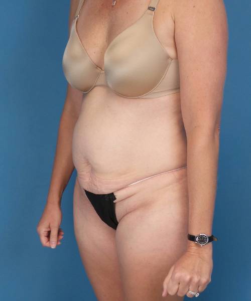 before tummy tuck left angle view female patient case 1745