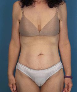 before tummy tuck front view female patient case 1652