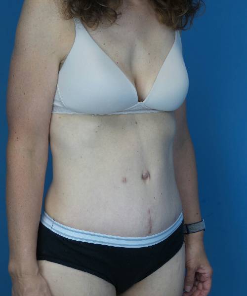 after tummy tuck angle view female patient case 1652