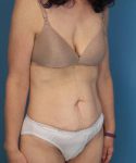 before tummy tuck angle view female patient case 1652