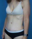 after tummy tuck left angle view female patient case 1652