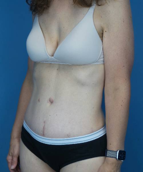 after tummy tuck left angle view female patient case 1652