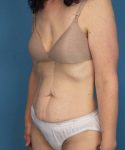 before tummy tuck left angle view female patient case 1652