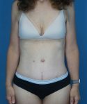 after tummy tuck front view female patient case 1652