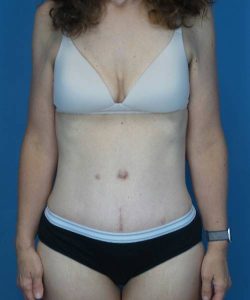 after tummy tuck front view female patient case 1652