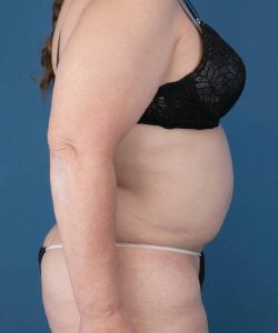 before tummy tuck right side view female patient cast 1607