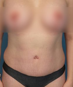 after tummy tuck front view female patient case 1947