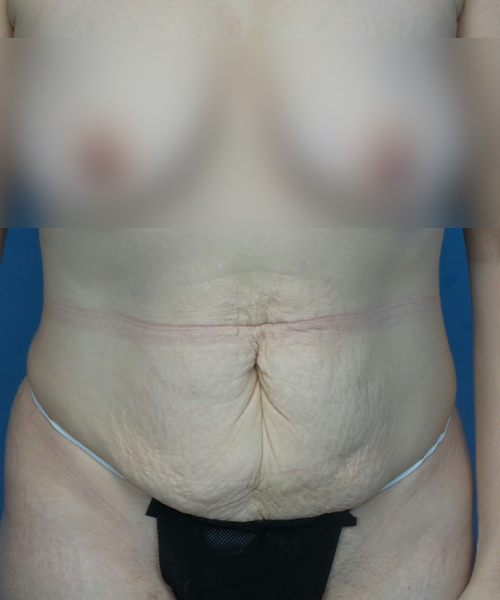 before tummy tuck front view female patient case 1947