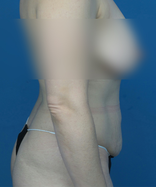 before tummy tuck right side view female patient case 1947