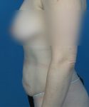 before tummy tuck left side view female patient case 1947