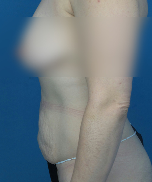 before tummy tuck left side view female patient case 1947