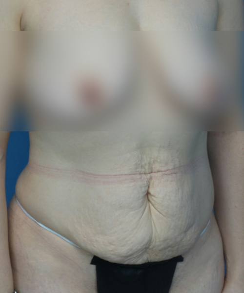 before tummy tuck right view female patient case 1947
