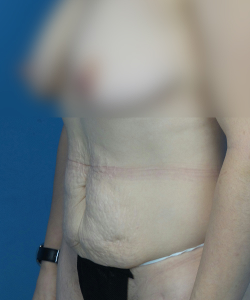 before tummy tuck left view female patient case 1947